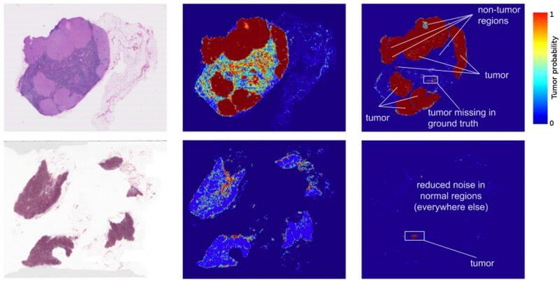 Image of Deep learning for cancer detection